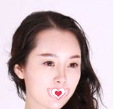 大龄女自述在沧州静港注射完玻尿酸分分钟面部饱满变萝莉 10天后法令纹和泪沟全消失 图2