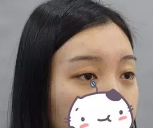 大同整形医院哪家好?说下我在美神整形做切开双眼皮20天恢复过程吧