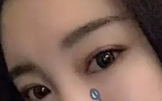 大同整形医院哪家好?说下我在美神整形做切开双眼皮20天恢复过程吧 图2