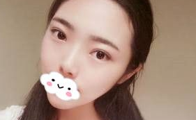 潍坊华美做全切双眼皮挺好的，分享我在潍坊华美做双眼皮的日记 案例图2