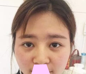 看了网上隆鼻价格后,我选择在大同美神整形做鼻综合隆鼻,展示前后对比照片