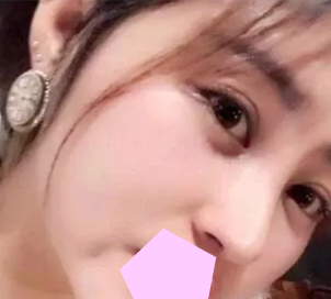 看了网上隆鼻价格后,我选择在大同美神整形做鼻综合隆鼻,展示前后对比照片 图2