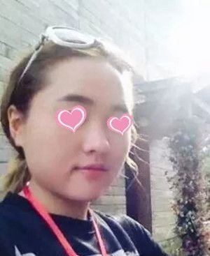 等了几个月才预约上宜春天泽的史希杰院长,给大家分享下我做隆鼻手术的恢复过程吧