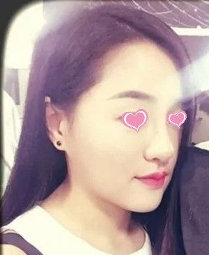 等了几个月才预约上宜春天泽的史希杰院长,给大家分享下我做隆鼻手术的恢复过程吧 图2