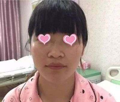 没想到上饶尚美张维华给我做的假体隆鼻效果这么好