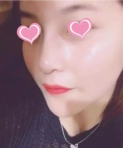 没想到上饶尚美张维华给我做的假体隆鼻效果这么好 图2