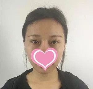 上饶尚美整形张维华做给我做全切双眼皮后,可算是把我之前埋线做坏的双眼皮拯救了