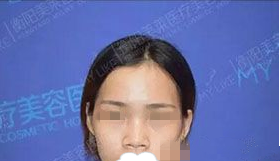 衡阳美莱芭比barbie混血美鼻整形怎么样,真人术前术后对比照片分享