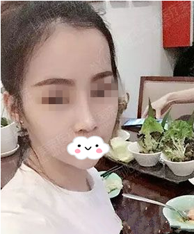 衡阳美莱芭比barbie混血美鼻整形怎么样,真人术前术后对比照片分享 图2