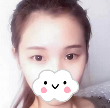 衡阳美莱双眼皮怎么样?分享我做的小清新双眼皮一个月后自然无痕的美美效果