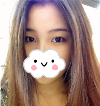 衡阳美莱双眼皮怎么样?分享我做的小清新双眼皮一个月后自然无痕的美美效果 图2
