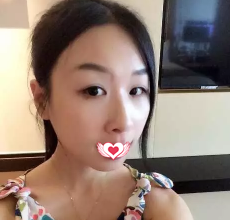 还在纠结去承德玥莱美或者美天做双眼皮手术?反正我已经找孙喜平医生做切开双眼皮美了5年