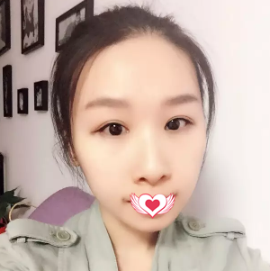 还在纠结去承德玥莱美或者美天做双眼皮手术?反正我已经找孙喜平医生做切开双眼皮美了5年 图2
