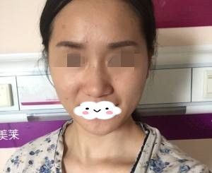 看了衡阳美莱真人案例后,还是选择了更适合自己的院长做了膨体隆鼻和缩鼻骨