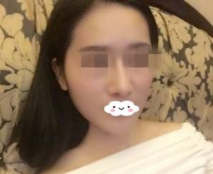 看了衡阳美莱真人案例后,还是选择了更适合自己的院长做了膨体隆鼻和缩鼻骨 图2