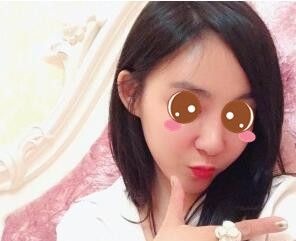 选择在锦州斯美诺整形做发际线种植3个月后 我的宽额头终于得救了 图2