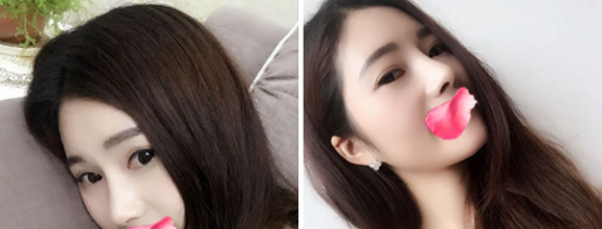 在烟台鹏爱整形医院同时做了全切双眼皮+鼻综合,也就是上上个月,到现在有两个月了,做的是肋软骨是会比较贵一点 图2
