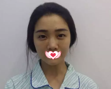 当你还在纠结要不要注射玻尿酸隆鼻时 我已经来唐山美联臣找白伟枫院长做硅胶隆鼻变翘鼻女神了