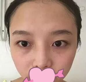 两个月前我面诊了锦州斯美诺整形医院耿成虎和周杰后我选择耿成虎做了全切双眼皮