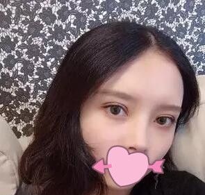 两个月前我面诊了锦州斯美诺整形医院耿成虎和周杰后我选择耿成虎做了全切双眼皮 图2