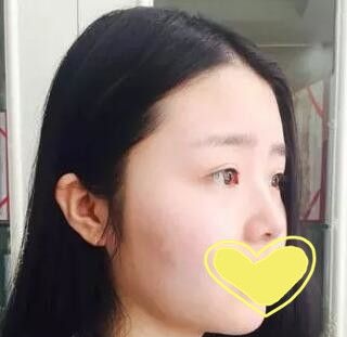 看闺蜜半年前找锦州斯美诺耿成虎做的假体隆鼻不错我也来做了个隆鼻