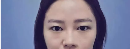 7月18日在汉中韩美整形医院常双模主任处做的全切双眼皮、内眼角,手术价格11000元