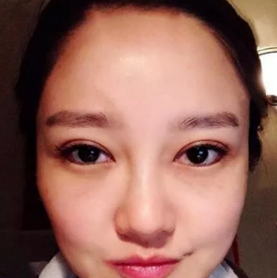 7月18日在汉中韩美整形医院常双模主任处做的全切双眼皮、内眼角,手术价格11000元 图2