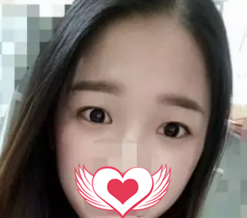 从单眼皮到双眼皮的改变到底有多大?来看我找唐山苏亚美联臣路卫国医生做双眼皮前后对比就知道