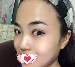 看到很多人做鼻综合失败 庆幸自己选择廊坊华康的刘文阁医生做硅胶隆鼻+耳软骨垫鼻尖还是挺靠谱的