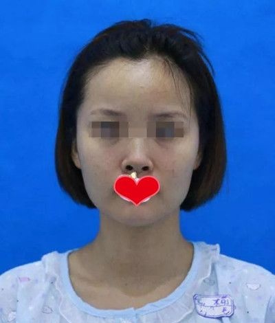 今年夏天去九江星瑞美做了鼻综合,没想到刘志强院长帮摆脱了朝天鼻