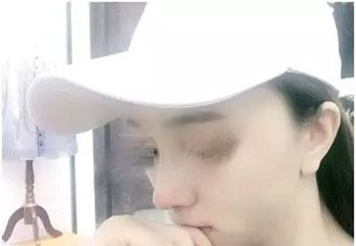 今年夏天去九江星瑞美做了鼻综合,没想到刘志强院长帮摆脱了朝天鼻 图2