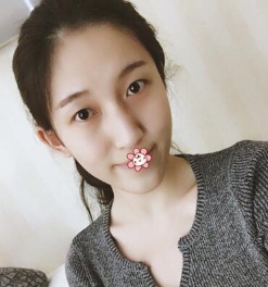 说老实话，宁夏华美整形美容医院何林给我割这双眼皮才叫真自然！
