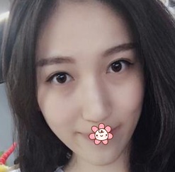 说老实话,宁夏华美整形美容医院何林给我割这双眼皮才叫真自然! 图2