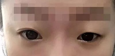 三个月前在九江星瑞美整形医院做了双眼皮手术,给大家分享下恢复情况吧