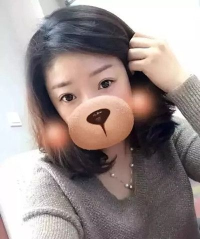 三个月前在九江星瑞美整形医院做了双眼皮手术,给大家分享下恢复情况吧 图2
