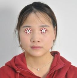 在董彭涛那儿做完膨体隆鼻+鼻综合发现宁夏华美整形美容医院口碑怎么样不是迷了。