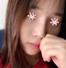 在董彭涛那儿做完膨体隆鼻+鼻综合发现宁夏华美整形美容医院口碑怎么样不是迷了。 图2
