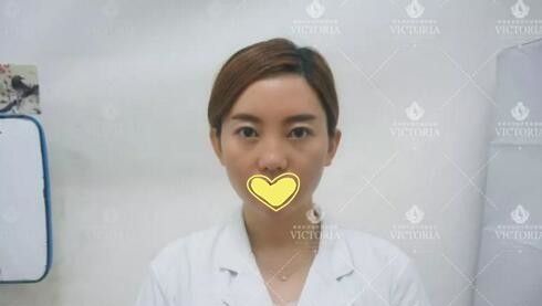 三亚维多利亚真人案例：自从段亦棋医生给我做了双眼皮后整个人都变得自信了