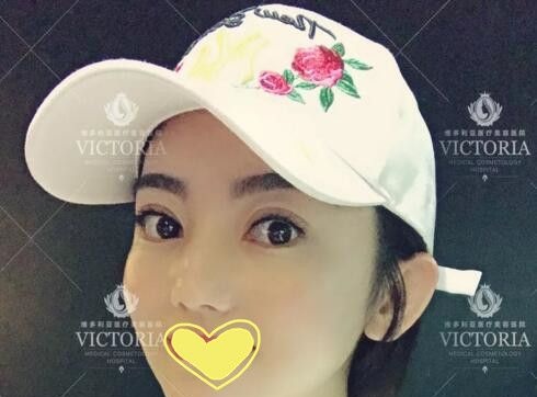 三亚维多利亚真人案例：自从段亦棋医生给我做了双眼皮后整个人都变得自信了 案例图2
