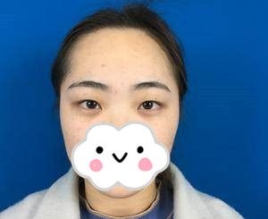 终于在湘潭雅美做了全切双眼皮，不到一个月恢复的这么好，我简直不敢相信