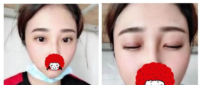 淮安华美双眼皮+祛斑一起做 只要20天就能告别20多年的小眼麻子脸 图2