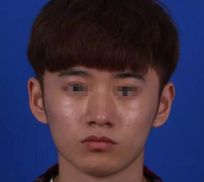 分享我找桂林时光美莱毛建文做鼻综合手术1个月就恢复的超级自然