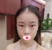 很庆幸自己找衡水天宏王慧东主任做鼻综合整形 术后只用22天就让我拥有精致小巧鼻