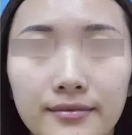 看了闺蜜在运城丽都整形做的激光祛斑效果，我去找杨顺新院长做了鼻综合