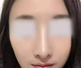 看了闺蜜在运城丽都整形做的激光祛斑效果,我去找杨顺新院长做了鼻综合 图2