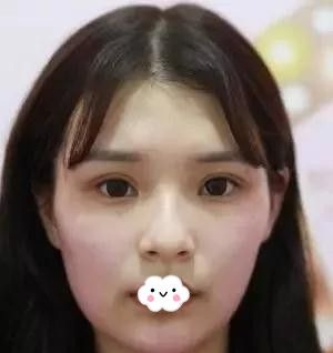 排斥假体还怕玻尿酸时间短到阜阳东方美莱坞做线雕隆鼻真人案例