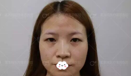 通过阜阳东方美莱坞高士乾切开双眼皮案例图了解阜阳做双眼皮哪家好?