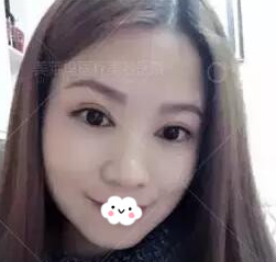 通过阜阳东方美莱坞高士乾切开双眼皮案例图了解阜阳做双眼皮哪家好? 图2