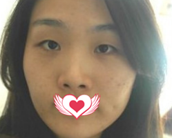 在邯郸京美做全切双眼皮15天就能恢复自然无痕 只能说荆万里医生的眼部整形技术太赞