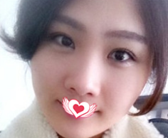 在邯郸京美做全切双眼皮15天就能恢复自然无痕 只能说荆万里医生的眼部整形技术太赞 图2